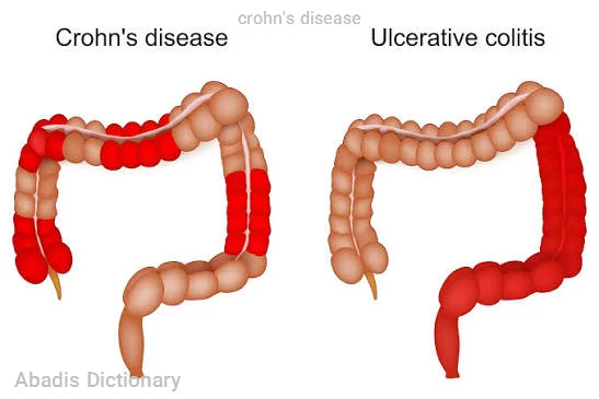 crohn